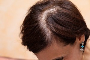 Brunette woman with a wide parting caused by hair loss